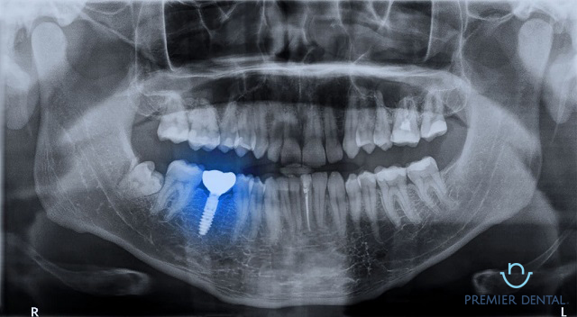 Chụp X-Quang cấy ghép răng là gì