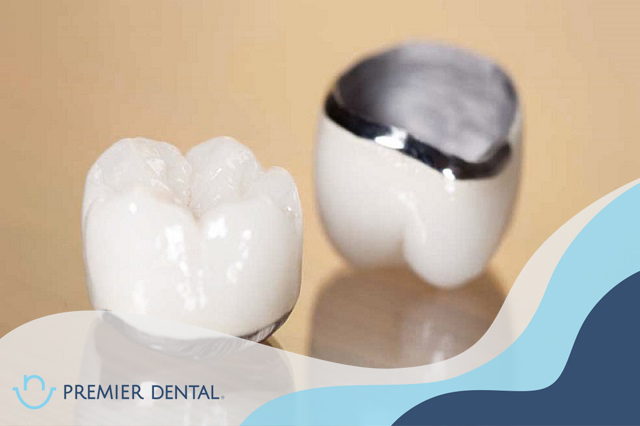 Răng implant là gì